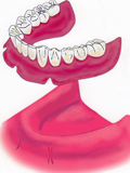 インプラントと義歯の組み合わせ