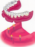 インプラントと義歯の組み合わせ